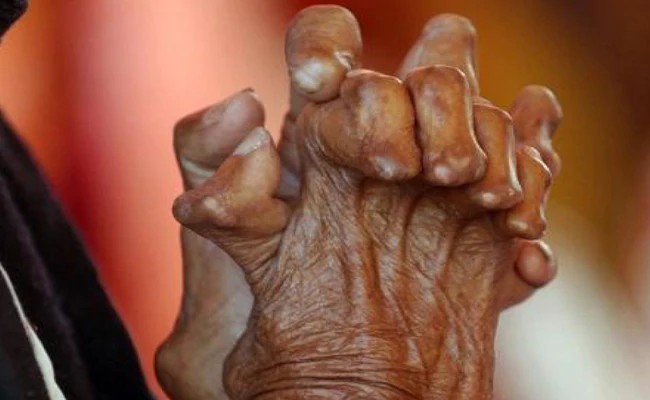 आज ६९औँ विश्व कुष्ठरोग दिवस