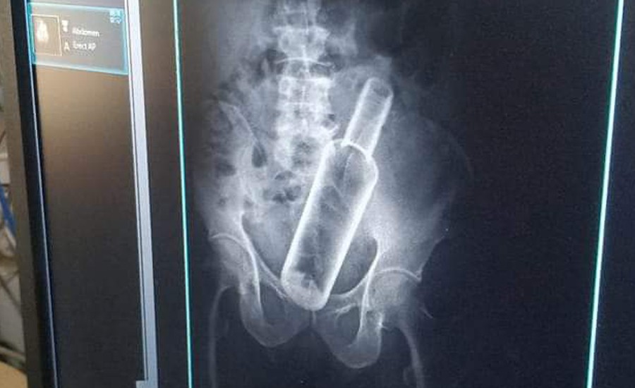 धनगढीमा वृद्धको पेटमा रक्सीको बोतल भेटिएपछि...