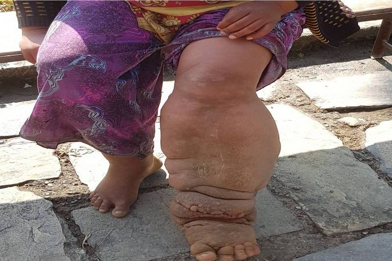 आजदेखि १२ जिल्लामा हात्तीपाइले रोगविरुद्धको औषधि खुवाइँदै