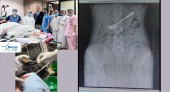 १७ वर्षीया किशोरीको पेटमा चम्चा अड्कियो, नर्भिकका चिकित्सकले बिना शल्यक्रिया निकाले
