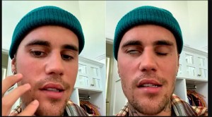 विश्व चर्चित पप गायक जस्टिन बिबरको अनुहारमा पक्षघात