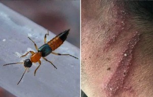 नैरोबी फ्लाईको लक्षण भएका बिरामी नेपालमा पनि फेला