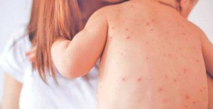 दादुरा संक्रमण : नेपालगञ्जमा झण्डै १० हजार बालबालिकालाई खोप वितरण