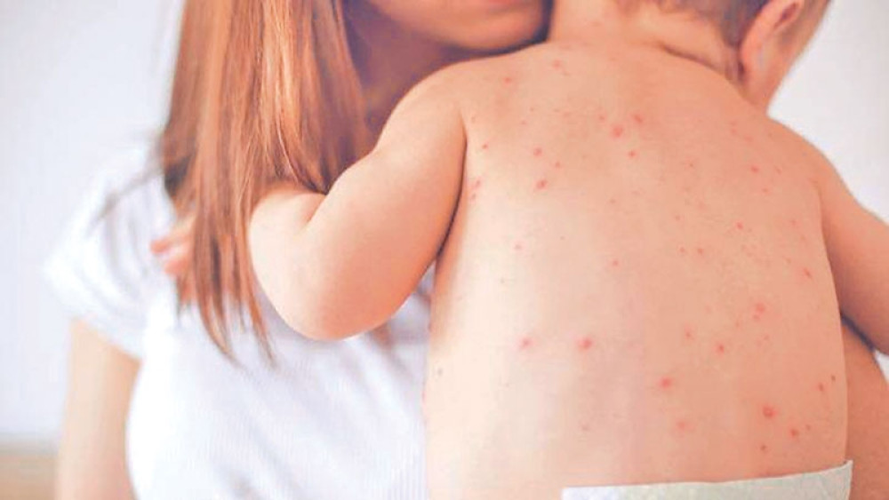 आइतबारदेखि देशभर दादुराविरुद्ध खोप अभियान, काठमाडौँका छ लाख बालबालिका समेटिँदै