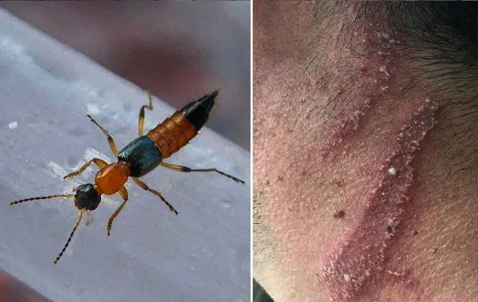 नैरोबी फ्लाईको लक्षण भएका बिरामी नेपालमा पनि फेला