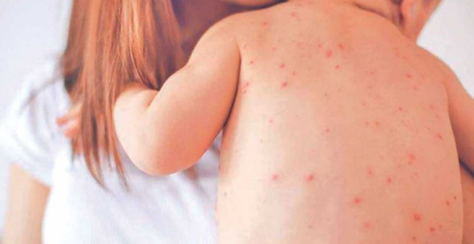 दादुरा संक्रमण : नेपालगञ्जमा झण्डै १० हजार बालबालिकालाई खोप वितरण