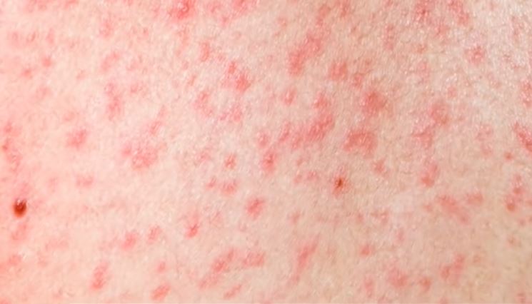 डोटीमा पनि दादुरा देखियो, एक बालकमा सङ्क्रमण