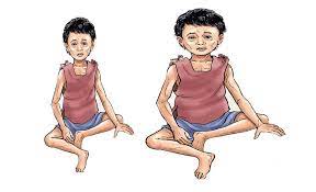 कुपोषित बालबालिकाको सङ्ख्या बढ्दै