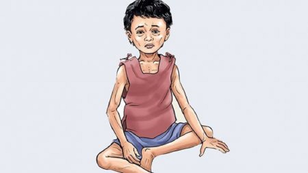 एसिया तथा प्रशान्त क्षेत्रमा कुपोषणको दर बढ्दो