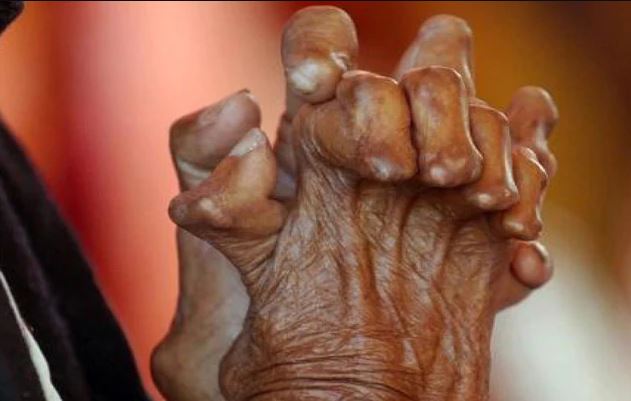 आज कुष्ठरोग विरुद्धको दिवस मनाइँदै