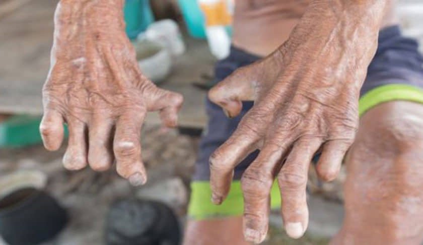 आज ७१ औँ विश्व कुष्ठरोग दिवस मनाइँदै